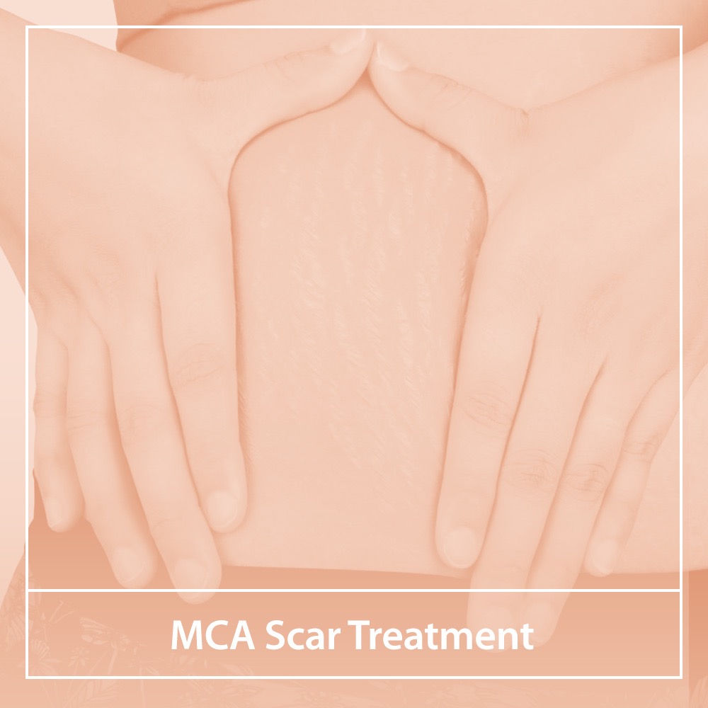 MCA Scar Treatment