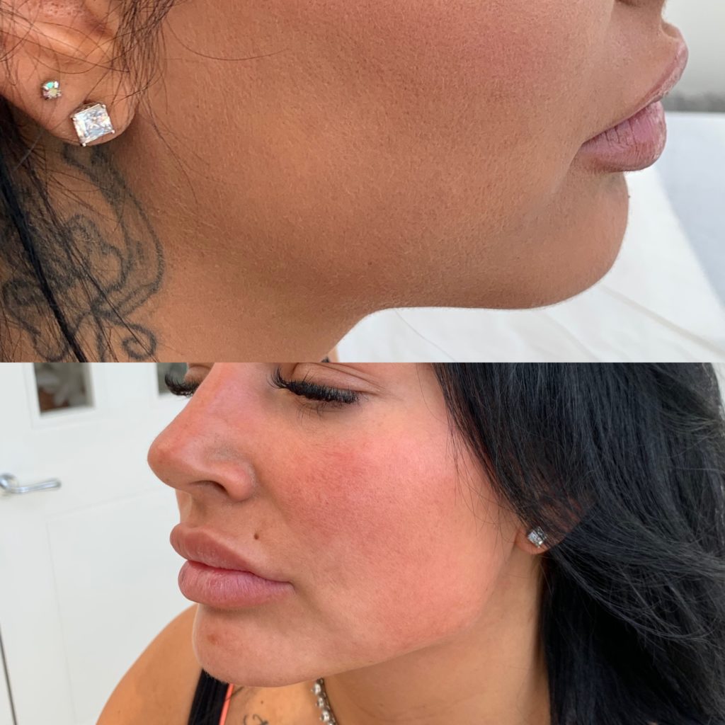 Derma Fillers Training