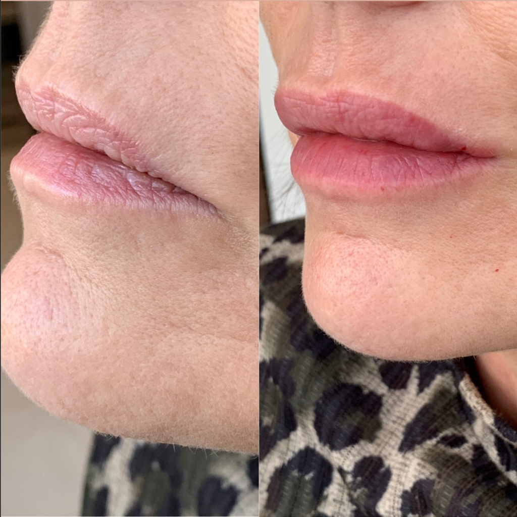 Lip Filler Course