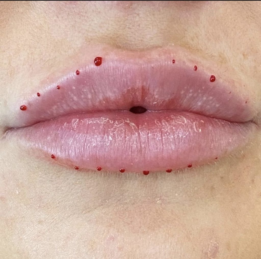 Lips Filler Training