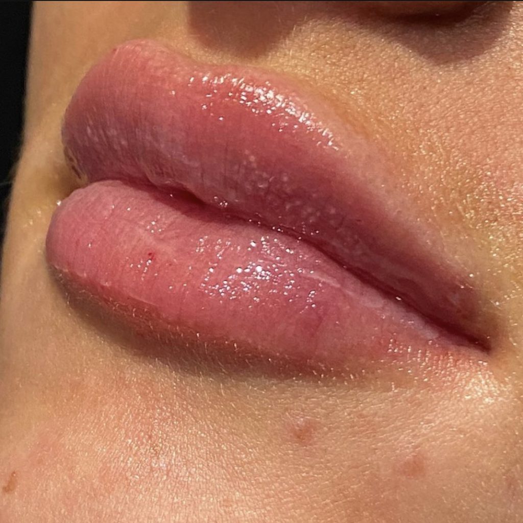 Chapped Lips