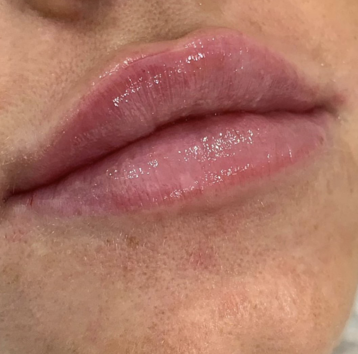 Russian Lip Filler Technique in Bexleyheath Eclipse Beauty