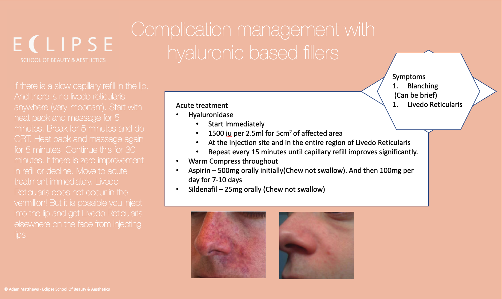 Video of a vascular occlusion from dermal fillers Eclipse