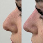 Liquid Rhinoplasty Mastercalss